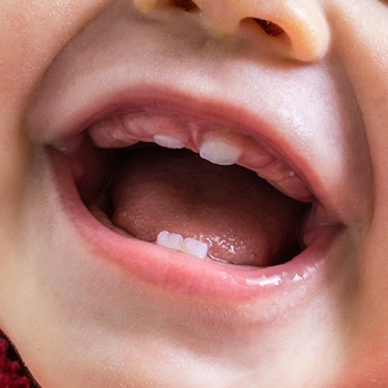 baby with primary teeth erupting