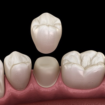 A digital image of a dental crown being placed over a prepped tooth on the lower arch of the mouth