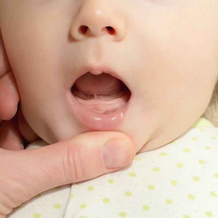 Dentist checking for lip and tongue tie